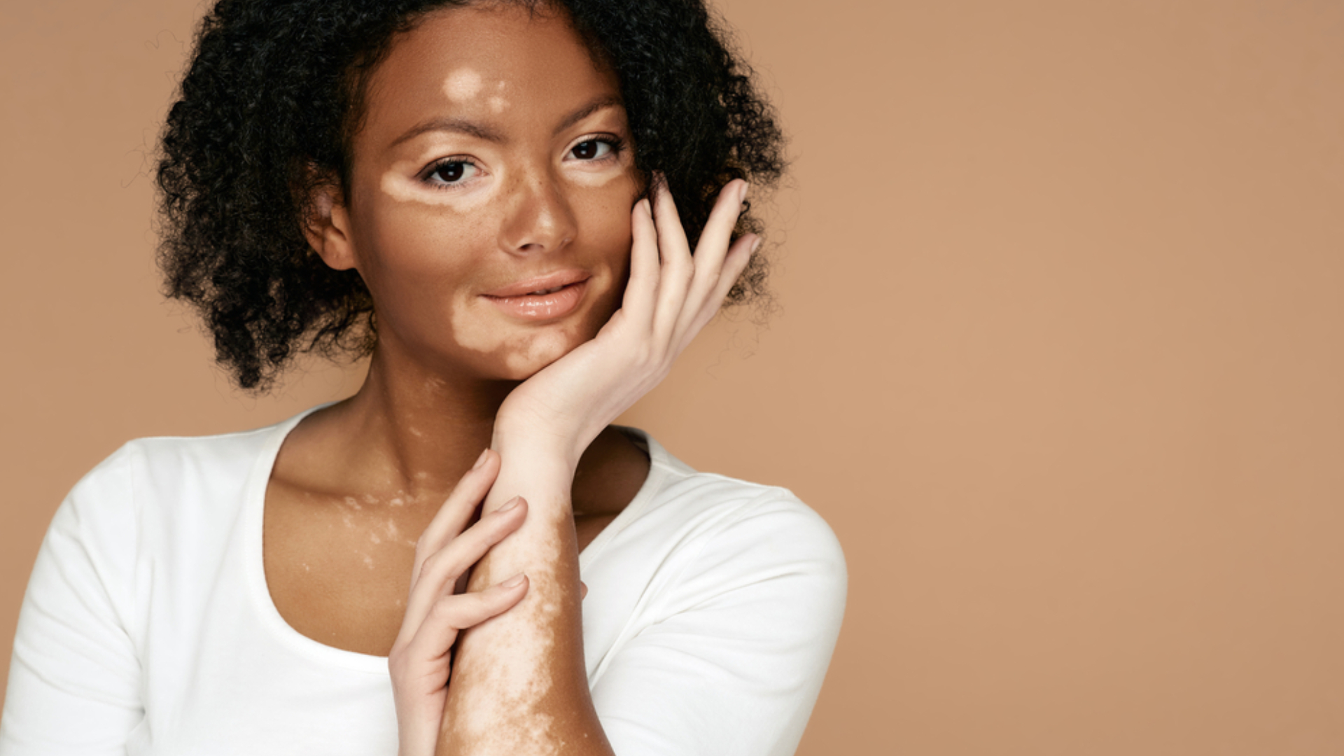 Understanding How Vitiligo is Connected to Military Service: Insights and Facts...